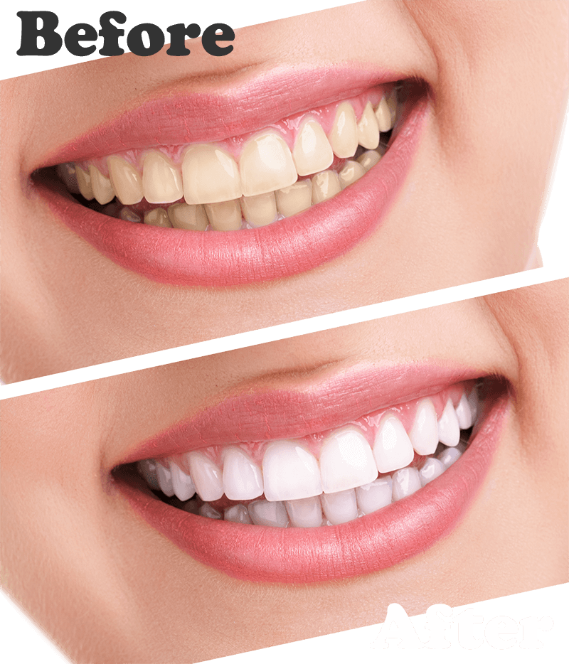 teeth-whitening-results Teeth whitening results, before and after