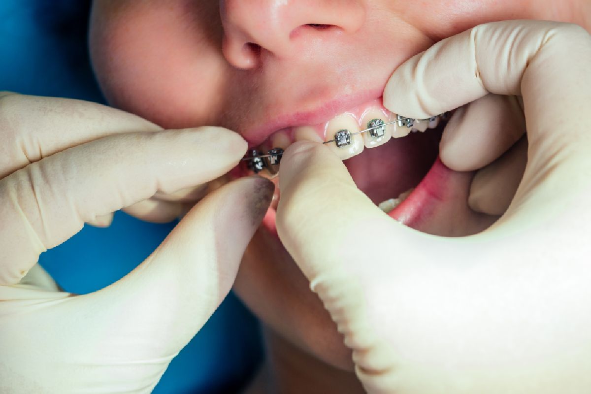 Close up of smile with clear braces
